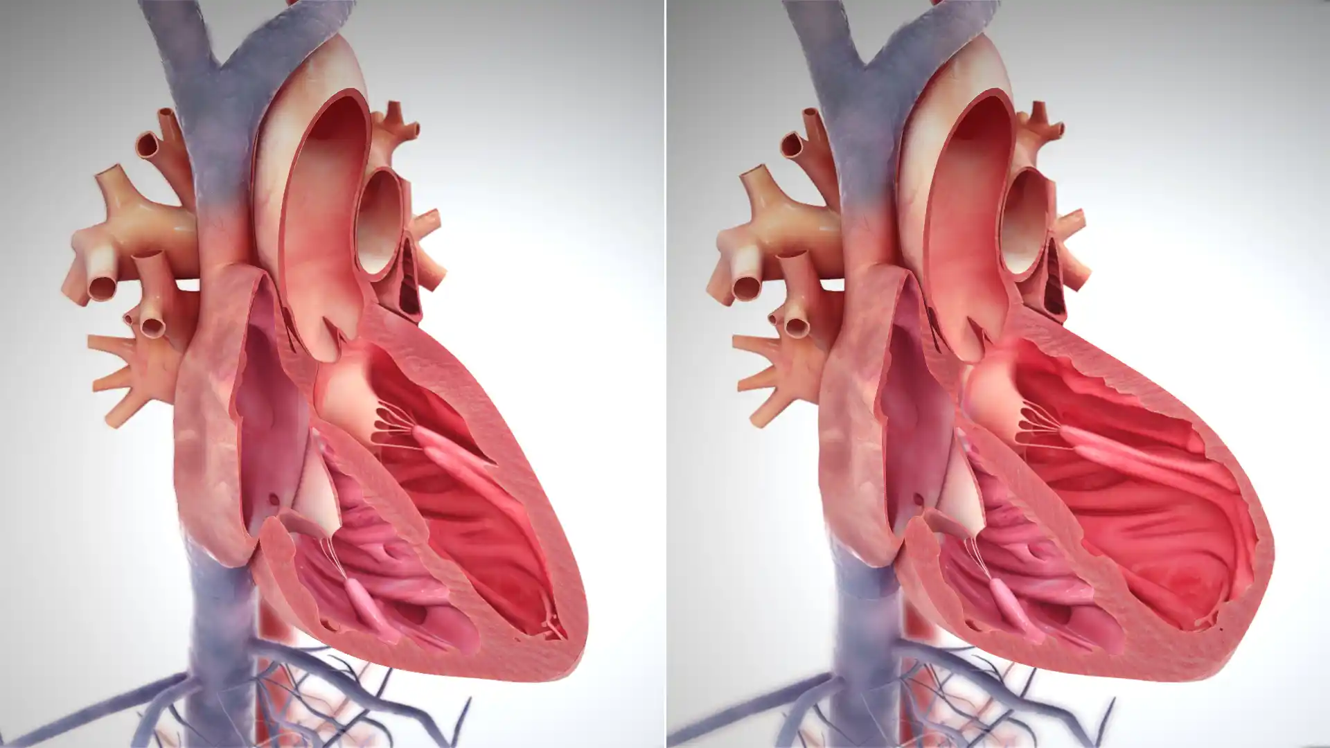 Pathology of Congenital Heart Diseases (CHD)
