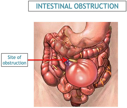 Medical illustration of an intestinal obstruction affecting the bowel.