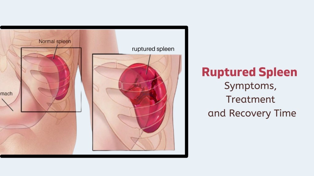Illustration showing a ruptured spleen and internal abdominal bleeding.