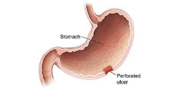 Illustration of a perforated stomach ulcer.